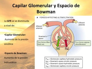 Capilar Glomerular y Espacio de
Bowman
La GFR se ve disminuida
a nivel de:
•Capilar Glomerular:
Aumento de la presión
oncótica
•Espacio de Bowman:
Aumento de la presión
hidrostática
 