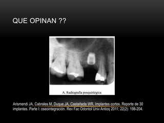 QUE OPINAN ??
Arismendi JA, Cabrales M, Duque JA, Castañeda WR. Implantes cortos. Reporte de 30
implantes. Parte I: oseointegración. Rev Fac Odontol Univ Antioq 2011; 22(2): 198-204.
 
