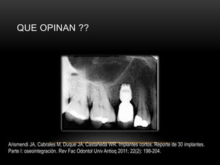QUE OPINAN ??
Arismendi JA, Cabrales M, Duque JA, Castañeda WR. Implantes cortos. Reporte de 30 implantes.
Parte I: oseointegración. Rev Fac Odontol Univ Antioq 2011; 22(2): 198-204.
 