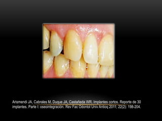 Arismendi JA, Cabrales M, Duque JA, Castañeda WR. Implantes cortos. Reporte de 30
implantes. Parte I: oseointegración. Rev Fac Odontol Univ Antioq 2011; 22(2): 198-204.
 