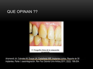 QUE OPINAN ??
Arismendi JA, Cabrales M, Duque JA, Castañeda WR. Implantes cortos. Reporte de 30
implantes. Parte I: oseointegración. Rev Fac Odontol Univ Antioq 2011; 22(2): 198-204.
 