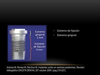 • Extremo de fijación
• Extremo gingival
Antonia M, Romeo M, Del Amo M, Implantes cortos en sectores posteriores. Revisión
bibliográfica GACETA DENTAL 207 octubre 2009 ;(pag 210-227),
 