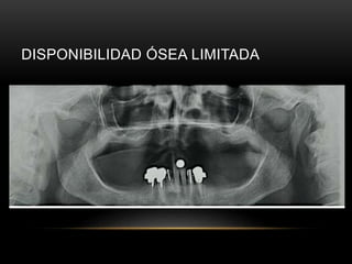 DISPONIBILIDAD ÓSEA LIMITADA
 