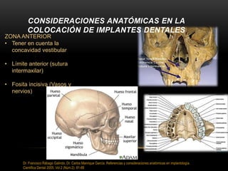 CONSIDERACIONES ANATÓMICAS EN LA
COLOCACIÓN DE IMPLANTES DENTALES
ZONA ANTERIOR
• Tener en cuenta la
concavidad vestibular
• Límite anterior (sutura
intermaxilar)
• Fosita incisiva (Vasos y
nervios)
Dr. Francisco Rábago Galindo, Dr. Carlos Manrique García. Referencias y consideraciones anatómicas en implantología.
Cientifica Dental 2005; Vol.2 (Núm.2): 81-88
 