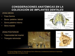 ZONA MEDIA
• Fosa Canina
• Surco palatino lateral
• Surco palatino interno
• Seno maxilar
ZONA POSTERIOR
• Tuberosidad del maxilar
• Triangulo retromolar
CONSIDERACIONES ANATÓMICAS EN LA
COLOCACIÓN DE IMPLANTES DENTALES
Dr. Francisco Rábago Galindo, Dr. Carlos Manrique García. Referencias y consideraciones anatómicas en implantología.
Cientifica Dental 2005; Vol.2 (Núm.2): 81-88
 