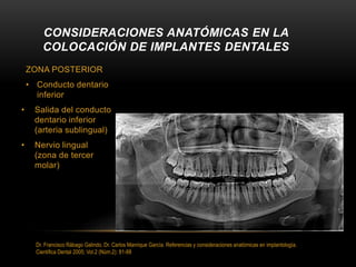 ZONA POSTERIOR
• Conducto dentario
inferior
• Salida del conducto
dentario inferior
(arteria sublingual)
• Nervio lingual
(zona de tercer
molar)
CONSIDERACIONES ANATÓMICAS EN LA
COLOCACIÓN DE IMPLANTES DENTALES
Dr. Francisco Rábago Galindo, Dr. Carlos Manrique García. Referencias y consideraciones anatómicas en implantología.
Cientifica Dental 2005; Vol.2 (Núm.2): 81-88
 
