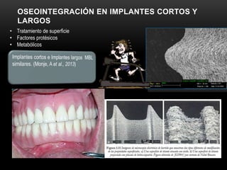 OSEOINTEGRACIÓN EN IMPLANTES CORTOS Y
LARGOS
• Tratamiento de superficie
• Factores protésicos
• Metabólicos
 