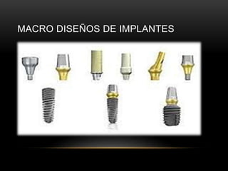 MACRO DISEÑOS DE IMPLANTES
 