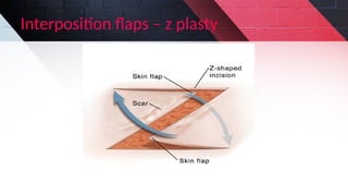 Interposition Flap Flaps used in Maxillofacial Surgery.pptx