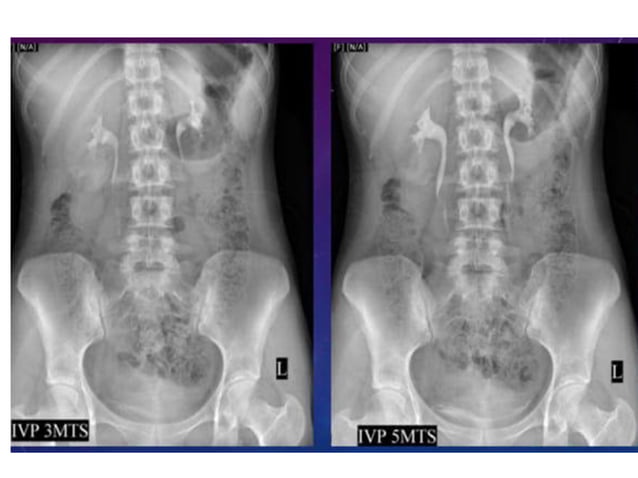 IVU radiology and imaging urogenital contrast | PPT