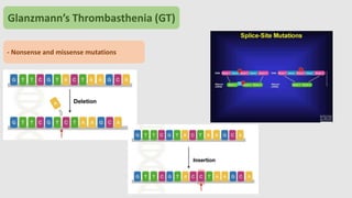 Glanzmann’s Thrombasthenia Symptoms
Petechia Epistaxis Gum bleeds
 