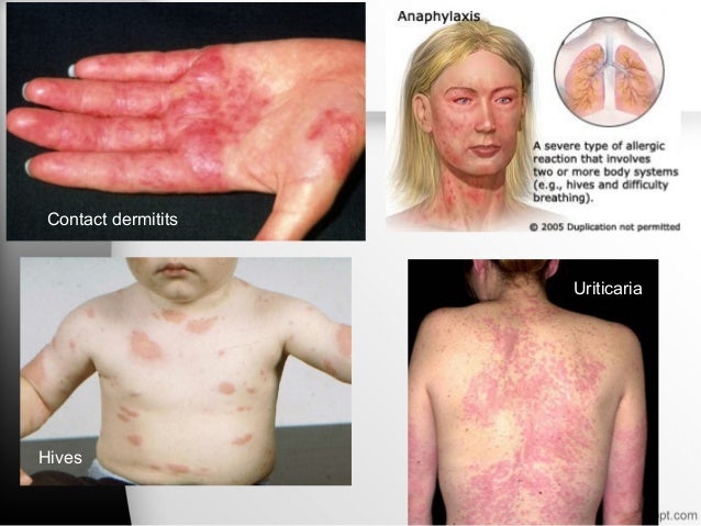 Allergy Due To Food Additives