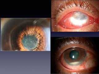 Causes of Toxic Anterior Segment Syndrome | PPTX