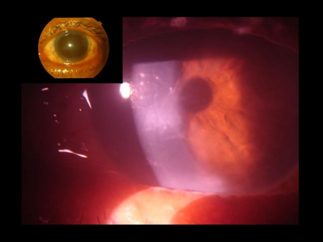 Causes of Toxic Anterior Segment Syndrome | PPTX | Eye and Vision ...