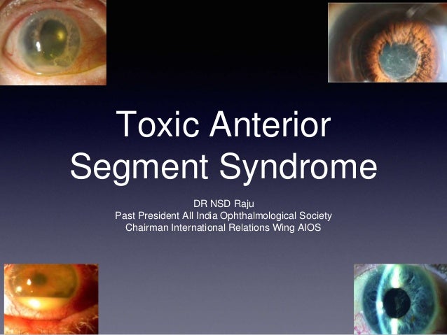 Causes of Toxic Anterior Segment Syndrome