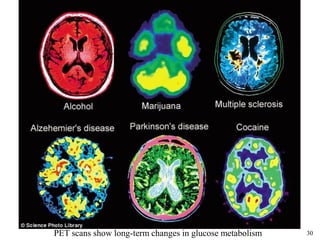 30
A brief History of Neuroscience
PET scans show long-term changes in glucose metabolism
 