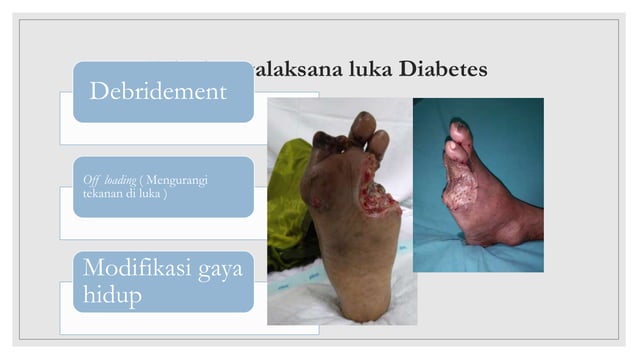 TATALAKSANA luka diabetes pembedahan.pptx