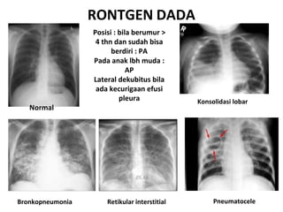 TATALAKSANA PNEUMONIA ANAK (EFIR).docx