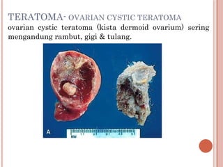 TERATOMA- OVARIAN CYSTIC TERATOMA
ovarian cystic teratoma (kista dermoid ovarium) sering
mengandung rambut, gigi & tulang.
 