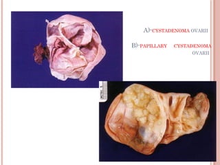 A)-CYSTADENOMA OVARII
B)-PAPILLARY CYSTADENOMA
OVARII
 