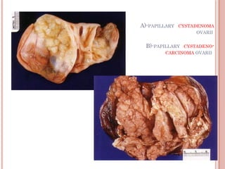A)-PAPILLARY CYSTADENOMA
OVARII
B)-PAPILLARY CYSTADENO-
CARCINOMA OVARII
 
