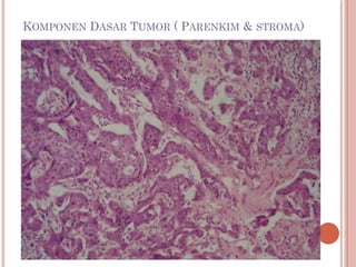 KOMPONEN DASAR TUMOR ( PARENKIM & STROMA)
 