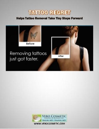 Helps Tattoo Removal Take Tiny Steps Forward
 