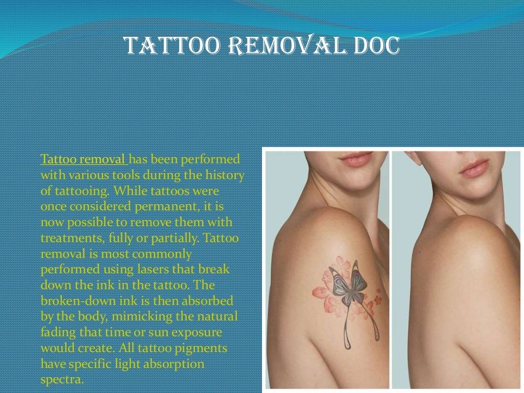 Laser Tattoo Removal Los Angeles | Tattoo Removal Los Angeles | Affordable Tattoo Removal Los