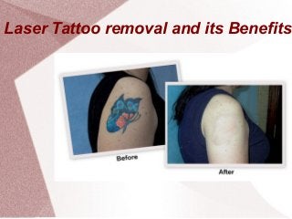 Video Dr U Answers Your Questions  Tattoo Removal With Laser  LA
