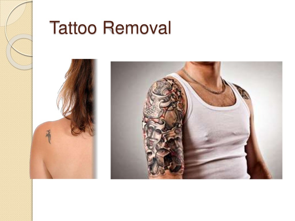 Tattoo removal henderson, nv