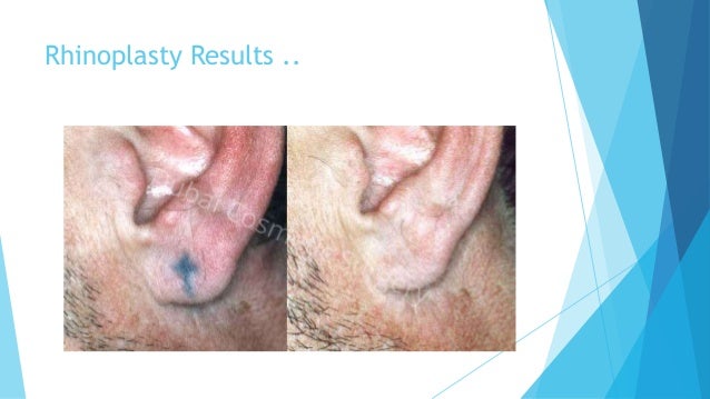 unwanted tattoos get best ideas from tattoo removal before and after u2026 unwanted tattoos get best ideas from tattoo removal before and after u2026