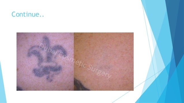 unwanted tattoos get best ideas from tattoo removal before and after u2026 unwanted tattoos get best ideas from tattoo removal before and after u2026