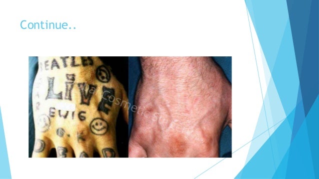 unwanted tattoos get best ideas from tattoo removal before and after u2026 unwanted tattoos get best ideas from tattoo removal before and after u2026