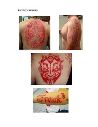ESCARIFICACIONES.
 