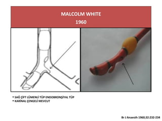  SAĞ ÇİFT LÜMENLİ TÜP ENDOBRONŞİYAL TÜP
 KARİNAL ÇENGELİ MEVCUT
Br J Anaesth 1960;32:232-234
 