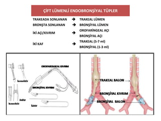 ÇİFT LÜMENLİ ENDOBRONŞİYAL TÜPLER
TRAKEADA SONLANAN  TRAKEAL LÜMEN
BRONŞTA SONLANAN  BRONŞİYAL LÜMEN
İKİ AÇI/KIVRIM 
OROFARİNGEAL AÇI
BRONŞİYAL AÇI
İKİ KAF 
TRAKEAL (5-7 ml)
BRONŞİYAL (1-3 ml)
 