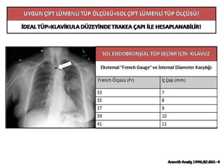 UYGUN ÇİFT LÜMENLİ TÜP ÖLÇÜSÜ=SOL ÇİFT LÜMENLİ TÜP ÖLÇÜSÜ!
İDEAL TÜP=KLAVİKULA DÜZEYİNDE TRAKEA ÇAPI İLE HESAPLANABİLİR!
SOL ENDOBRONŞİAL TÜP SEÇİMİ İÇİN KILAVUZ
ÖLÇÜLEN
TRAKEA
ÇAPI
(mm)
TAHMİN
EDİLEN
SOL ANA
BRONŞ
ÇAPI (mm)
ÇİFT
LÜMENLİ
TÜP ÖLÇÜSÜ
(Fr)
TÜP DIŞ ÇAPI (mm)
ANA
GÖVDE
SOL
LÜMEN
≥18 ≥12.2 41 14-15 10.6
≥16 ≥10.9 39 13-14 10.1
≥15 ≥10.2 37 13-14 10.0
≥14 ≥9.5 35 12-13 9.5
Anesth Analg 1996;82:861–4
 