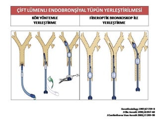 UYGUN TÜP SEÇİMİ=SOL ÇİFT LÜMENLİ TÜP ÖLÇÜSÜ
ENDOBRONŞİYAL TÜP BOYU MESAFESİ KADIN VE ERKEKTE FARKLILIK GÖSTERMEZ
ORTALAMA 170 cm BOY İÇİN 29 cm’dir
HER 10 cm BOY FARKI İÇİN 1 cm EKLENİR (29±1-2 cm)
TÜP MESAFESİ=0.75 X (KLAVİKULA-KARİNA MESAFESİ-cm)10 + 0.112 x BOY(cm)+ 6
Anesth Analg 1991;73:570–2
 