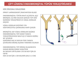 ÇİFT LÜMENLİ ENDOBRONŞİYAL TÜPÜN YERLEŞTİRİLMESİ
KÖR YÖNTEMLE YERLEŞTİRME
DİREKT LARİNGOSKOPİ /MACHINTOSH BLADE
ENDOBRONŞİYAL TÜPÜN MAVİ UÇ/DİSTAL AÇI/
BRONŞİAL UÇ ÖNE GELECEK ŞEKİLDE TÜP AĞİZ
İÇERİSİNE YERLEŞTİRİLİR VE VOKAL KORDLAR
GEÇİLİR
VOKAL KORDLAR GEÇİLİNCE YOL
GÖSTERİCİ/STİLE ÇIKARILMAZ HAFİF ÇEKİLİR
BRONŞİYAL KAF VOKAL KORDLARI GEÇİNCE
ENDOBRONŞİYAL TÜP HANGİ TARAFA
YERLEŞTİRİLECEKSE MAVİ UÇ O TARAFA DOĞRU
90° ÇEVRİLİR
GEREKİRSE BAŞ VE BOYUN TERS TARAFA
ÇEVRİLEREK BRONŞ AÇISINA YARDIMCI OLUNUR
ENDOBRONŞİYAL TÜP DİRENÇ OLUŞUNCAYA
KADAR BRONŞ İÇİNDE İLERLETİLİR
BU MESAFE ORTALAMA 170 CM BOY İÇİN 29
CM’İR
HER 10 CM İÇİN 1 CM EKLENİR (29±2 1-2 CM)
 