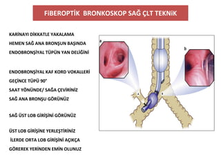 FiBEROPTİK BRONKOSKOP SAĞ ÇLT TEKNiK
KARİNAYI DİKKATLE YAKALAMA
HEMEN SAĞ ANA BRONŞUN BAŞINDA
ENDOBRONŞİYAL TÜPÜN YAN DELİĞİNİ
ENDOBRONŞİYAL KAF KORD VOKALLERİ
GEÇİNCE TÜPÜ 90°
SAAT YÖNÜNDE/ SAĞA ÇEVİRİNİZ
SAĞ ANA BRONŞU GÖRÜNÜZ
SAĞ ÜST LOB GİRİŞİNİ GÖRÜNÜZ
ÜST LOB GİRİŞİNE YERLEŞTİRİNİZ
İLERDE ORTA LOB GİRİŞİNİ AÇIKÇA
GÖREREK YERİNDEN EMİN OLUNUZ
 