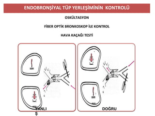 ENDOBRONŞİYAL TÜP YERLEŞİMİNİN KONTROLÜ
OSKÜLTASYON
FİBER OPTİK BRONKOSKOP İLE KONTROL
HAVA KAÇAĞI TESTİ
YANLI
Ş
DOĞRU
 