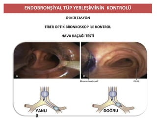 ENDOBRONŞİYAL TÜP YERLEŞİMİNİN KONTROLÜ
OSKÜLTASYON
FİBER OPTİK BRONKOSKOP İLE KONTROL
HAVA KAÇAĞI TESTİ
YANLI
Ş
DOĞRU
 