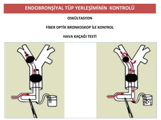 ENDOBRONŞİYAL TÜP YERLEŞİMİNİN KONTROLÜ
OSKÜLTASYON
FİBER OPTİK BRONKOSKOP İLE KONTROL
HAVA KAÇAĞI TESTİ
 