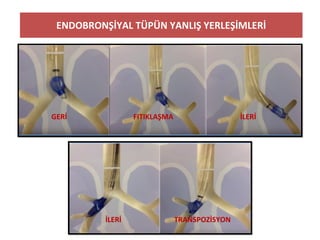 ENDOBRONŞİYAL TÜPÜN YANLIŞ YERLEŞİMLERİ
GERİ FITIKLAŞMA İLERİ
İLERİ TRANSPOZİSYON
 