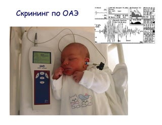 OAE
Screening
   Test
 