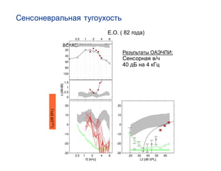 E.O. ( 82   )

               BC=AC
                                               :
                                           /
                             40        4
LDP [dB SPL]
 
