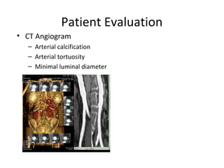 Patient Evaluation
• CT Angiogram
  – Arterial calcification
  – Arterial tortuosity
  – Minimal luminal diameter
 