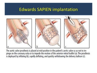 Edwards SAPIEN implantation
 