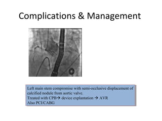Complications & Management




 Left main stem compromise with semi-occlusive displacement of
  Left main stem compromise with semi-occlusive displacement of
 calcified nodule from aortic valve.
  calcified nodule from aortic valve.
 Treated with CPB device explantation  AVR
  Treated with CPB device explantation  AVR
 Also PCI/CABG
  Also PCI/CABG
 