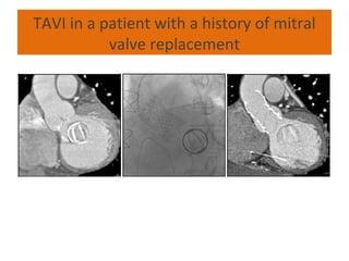 TAVI in a patient with a history of mitral
           valve replacement
 